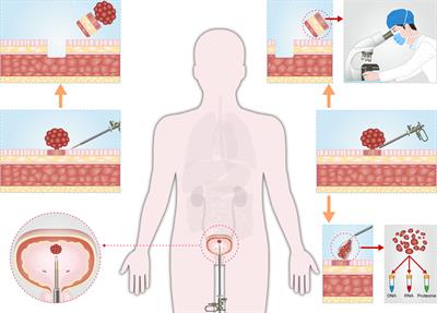 Precise diagnosis and treatment of non-muscle invasive bladder cancer - A clinical perspective